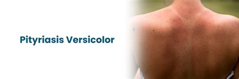 Consigli per la prevenzione della Pitiriasi Versicolor