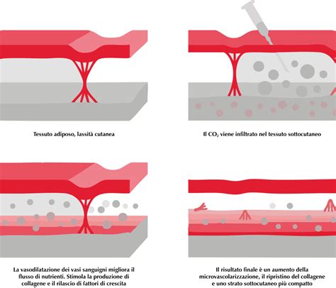Donne con cellulite prima e dopo carbossiterapia
