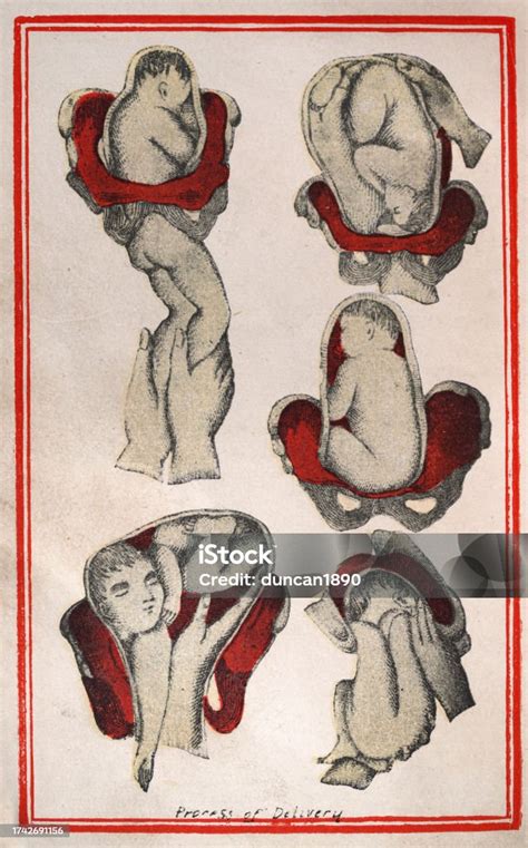 Storia del parto e della chirurgia ostetrica