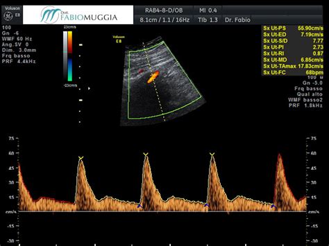 Grafico che illustra le onde flussimetriche delle arterie uterine