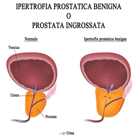 Diagramma dell'effetto dell'ortica sull'iperplasia prostatica benigna