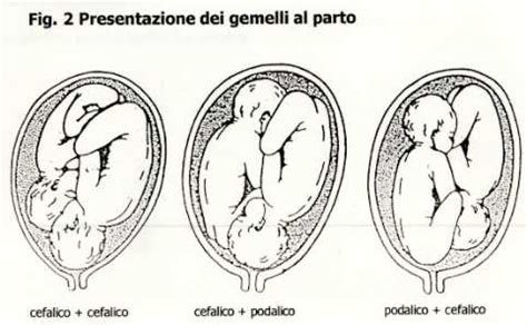 Immagine di pancia in gravidanza gemellare