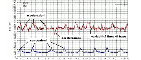 grafico che illustra il tracciato cardiotocografico normale