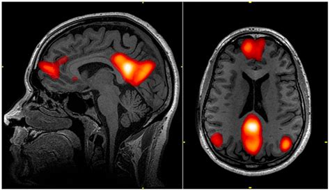 Grafico attivazione cerebrale fNIRS