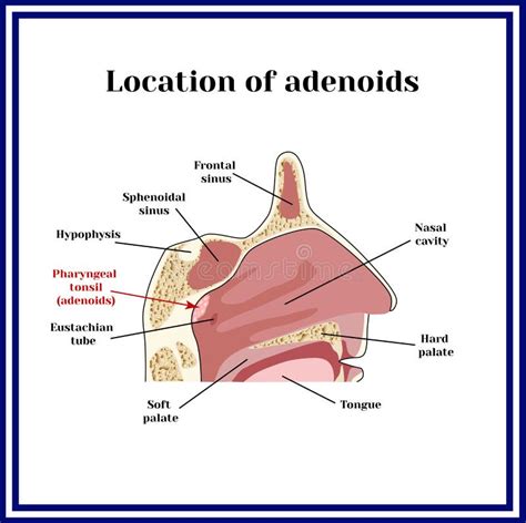 Illustrazione delle adenoidi e della loro posizione