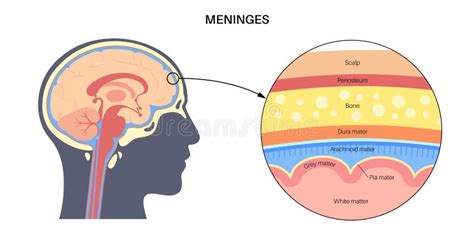 Schema anatomico delle meningi e delle diverse sedi di ematoma intracranico