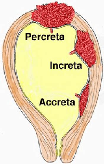 Placenta accreta types diagram