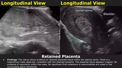 Ultrasound image of retained placental tissue