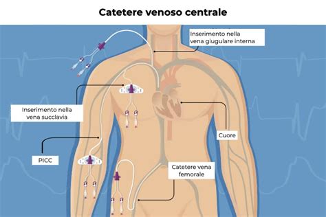 Illustrazione schematica dell'accesso all'arteria femorale e inserimento del catetere