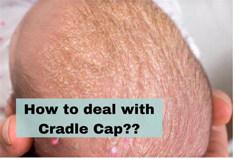 Appearance of cradle cap on a baby's scalp