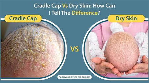 Comparison of cradle cap vs atopic dermatitis in infants