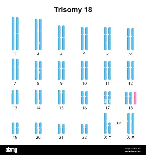 infografica che illustra le trisomie 21, 18 e 13 a confronto con il corredo cromosomico normale