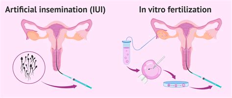 Diagramma Inseminazione Intrauterina (IUI)