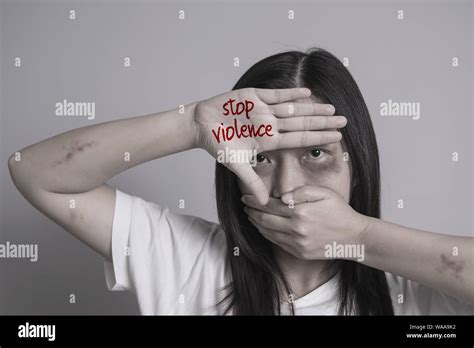 Donna con lividi sul volto, simbolo di violenza domestica