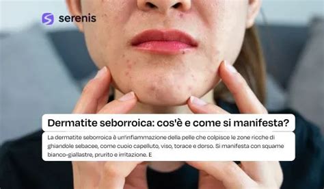 infografica comparativa tra la dermatite seborroica del neonato e quella dell'adulto