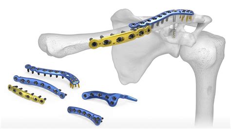 rappresentazione schematica di una placca di fissazione su clavicola fratturata