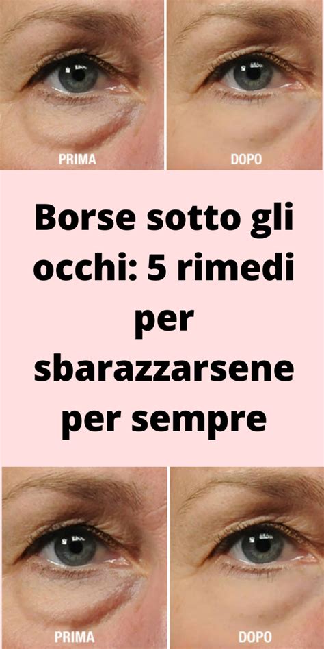 Occhiaie e borse sotto gli occhi come segni di squilibrio renale