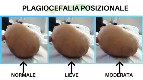Cranio di neonato con e senza plagiocefalia