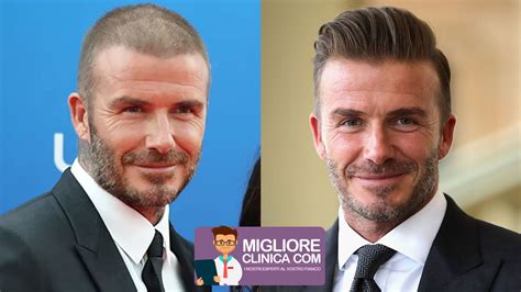 infografica che mostra la cronologia di crescita dei capelli dopo un trapianto FUE