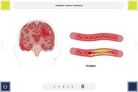 Immagine della trombosi venosa cerebrale