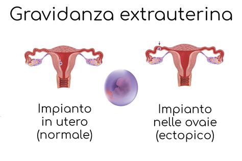 Schema anatomico che illustra le possibili sedi di una gravidanza extrauterina