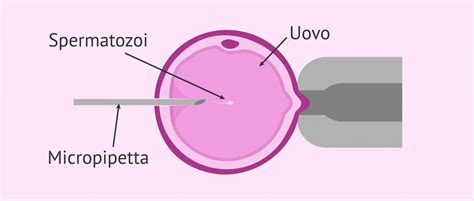 Schema dell'iniezione intracitoplasmatica dello spermatozoo (ICSI)
