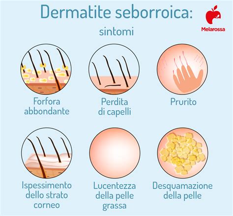 Cause della Dermatite Seborroica