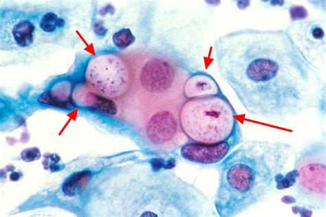 Microscopio con batteri Neisseria gonorrhoeae e Chlamydia trachomatis
