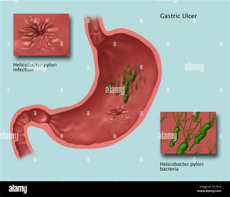 Stomaco con ulcera sanguinante