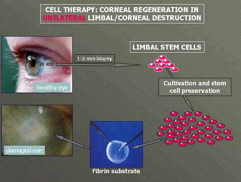 diagramma che illustra il ruolo delle cellule staminali limbari nella rigenerazione corneale