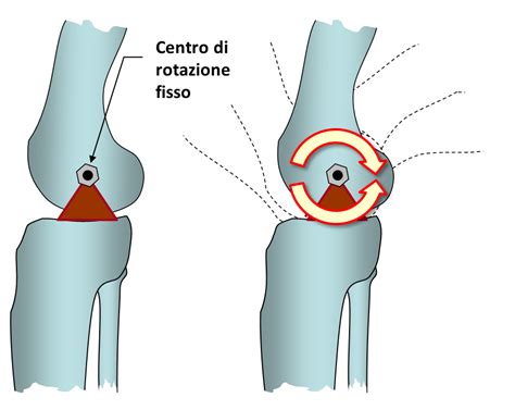Schema delle procedure chirurgiche per il ginocchio flesso