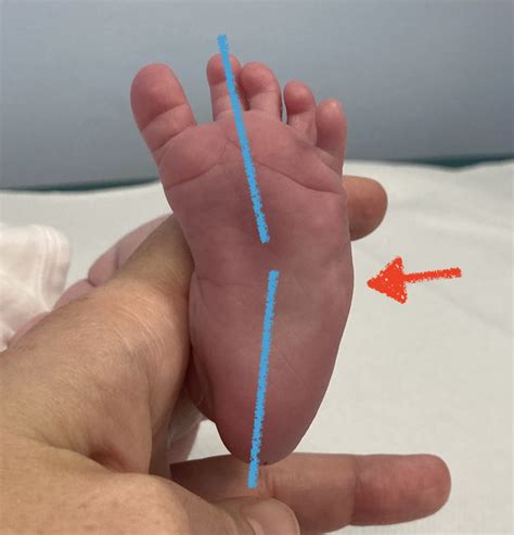 Piede neonatale con metatarso varo e la sua caratteristica curvatura a C