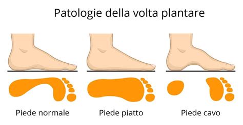 Diagramma comparativo delle principali deformità del piede neonatale