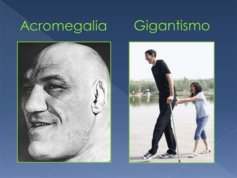 Confronto tra Gigantismo e Acromegalia