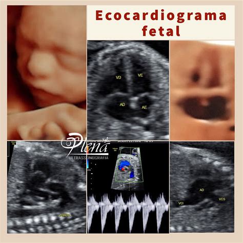 Ecodoppler fetale