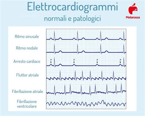 schema grafico sulla distribuzione dell'attività cerebrale durante l'arresto cardiaco