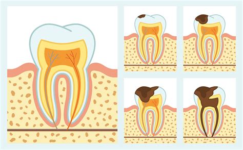 Schema comparativo tra erosione dentale e carie