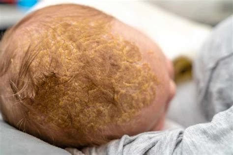 Bambino con crosta lattea sul cuoio capelluto