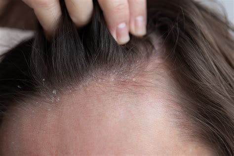 Dermatite seborroica in un adulto