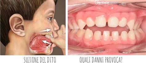 Danni palato ciuccio