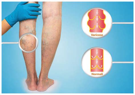 Gambe con vene varicose e capillari