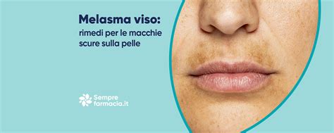 Esempio di melasma gravidico sul viso