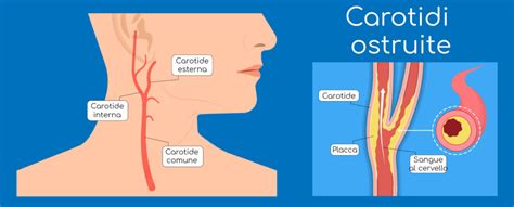 rappresentazione schematica dell'albero vascolare carotideo e delle sedi di biforcazione