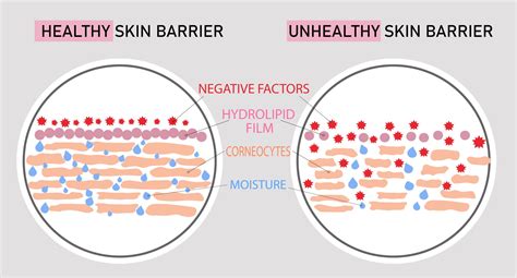 Diagram showing healthy vs. irritated skin barrier