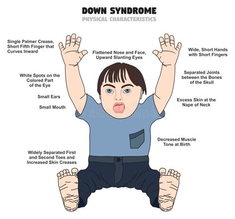 infografica sulle caratteristiche fisiche tipiche della sindrome di Edwards