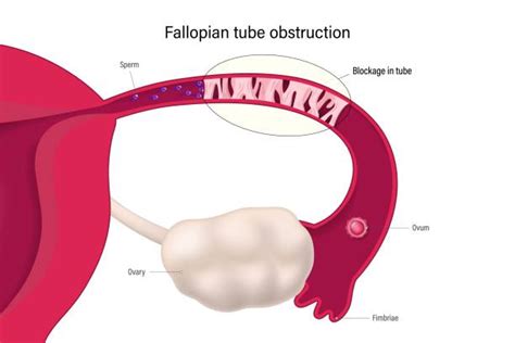 Illustrazione delle tube di Falloppio