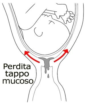 Tappo mucoso in gravidanza