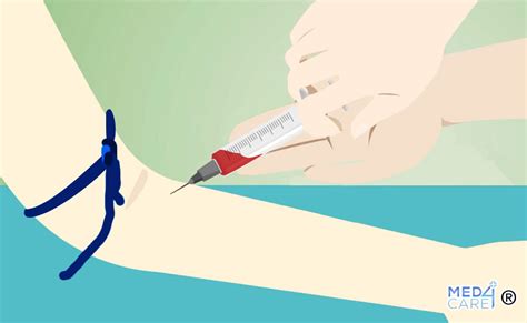 schema del prelievo di sangue materno per NIPT
