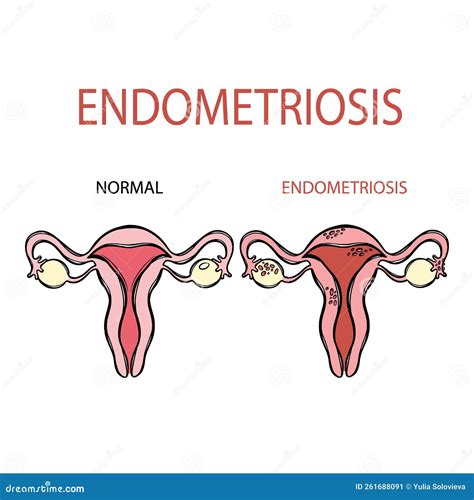 Illustrazione di endometriosi