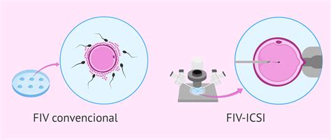 Diagramma che illustra la FIV convenzionale vs ICSI